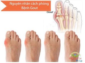 bênh gout phòng khám thuận kiều