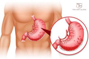 xuất huyết tiêu hoá