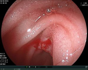 xuất huyết tiêu hoá phòng khám thuận kiều