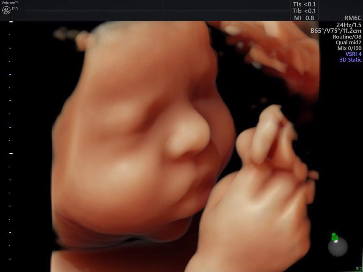 Bạn muốn nhìn thấy hình ảnh chân thật về em bé của mình? Hãy xem các hình ảnh siêu âm 4D thai. Với độ phân giải cao, bạn sẽ được chiêm ngưỡng những hình ảnh tuyệt đẹp và chân thực về khuôn mặt, cánh tay, chân và các cơ quan khác của em bé của bạn. Hãy cùng chúng tôi tận hưởng khoảnh khắc đặc biệt này trong tình yêu và sự kỳ diệu.