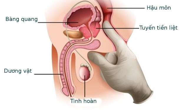 4. Triệu chứng của viêm tuyến tiền liệt